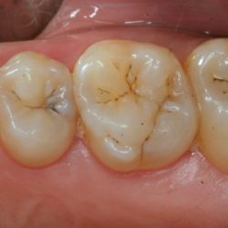 Fissure teeth tooth decay fissures stained seals staining dental sealed grooves prevent resulting bacteria