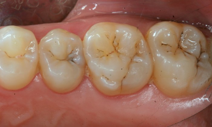 Fissure teeth tooth decay fissures stained seals staining dental sealed grooves prevent resulting bacteria