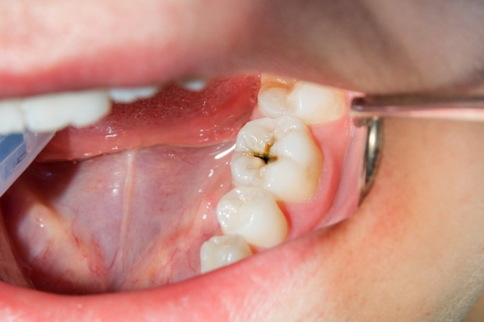 Pit and fissure stains or cavities