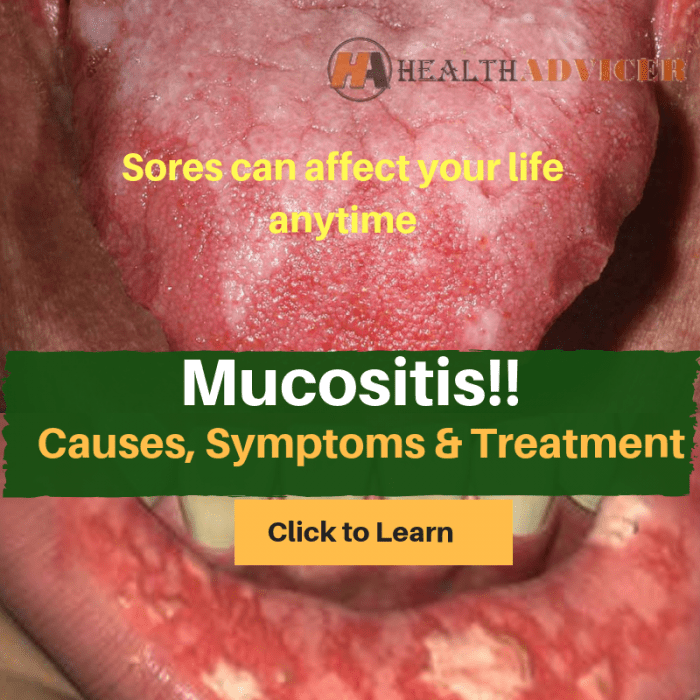 Mucositis treatment causes symptoms diagnosis healthadvicer