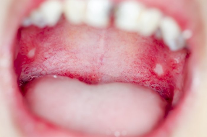 Mucositis erythematous mucosa obvious radiated irradiated demarcation eaom